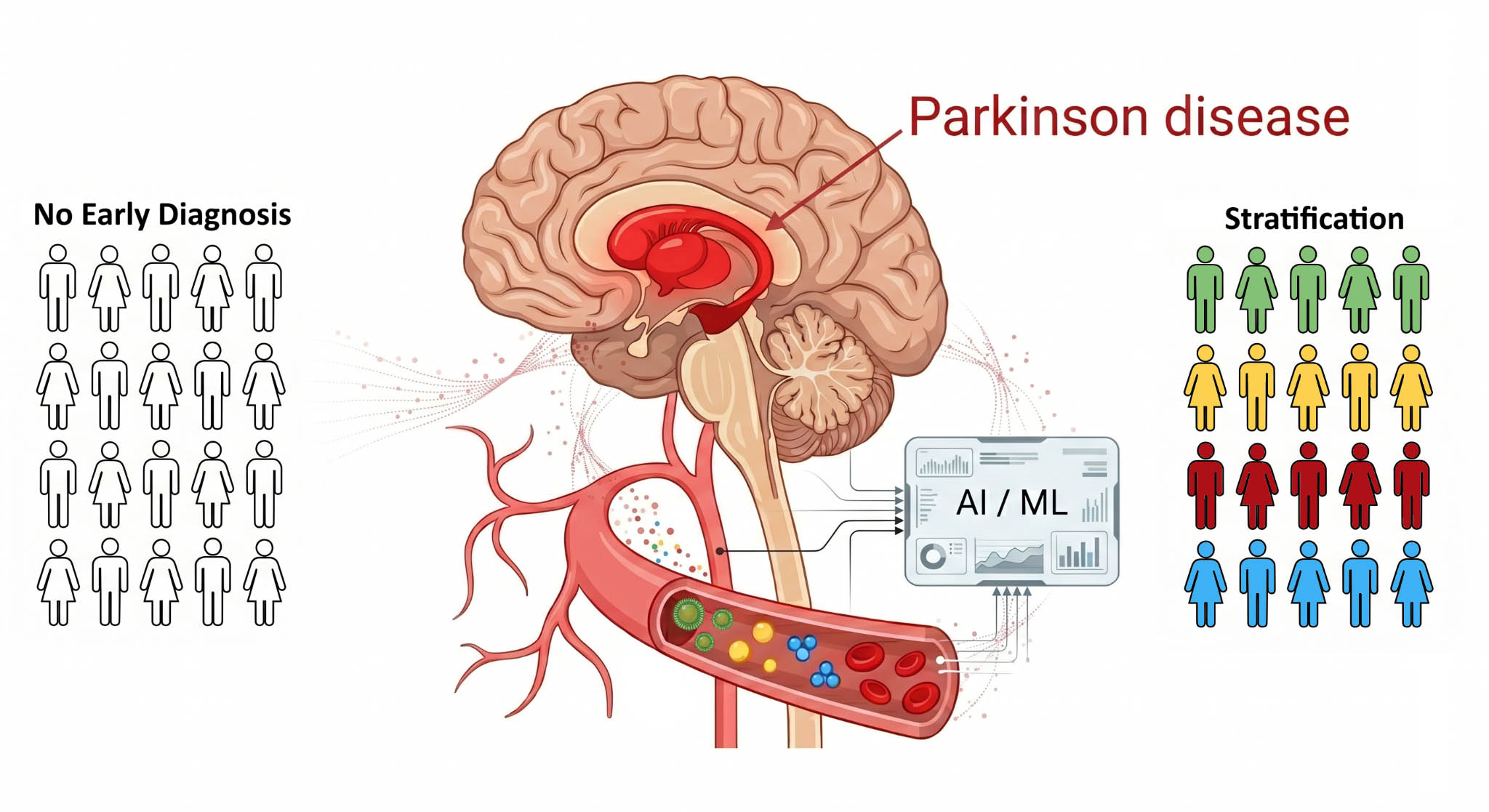 L'immagine rappresenta uno schema del cervello e dei vasi sanguigni che illustra la malattia di Parkinson, con riferimenti all'intelligenza artificiale per diagnosi e stratificazione dei pazienti.